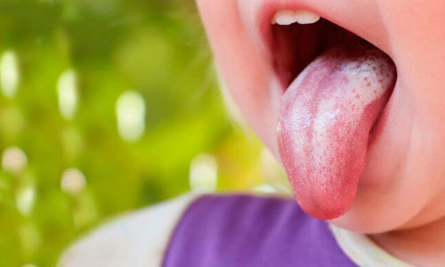 6 Easy & Effective Ayurvedic home remedies to cure Oral Thrush